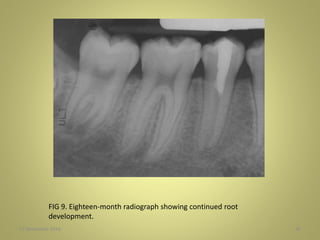 27 November 2016 56
FIG 9. Eighteen-month radiograph showing continued root
development.
 