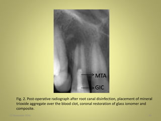 27 November 2016 59
Fig. 2. Post-operative radiograph after root canal disinfection, placement of mineral
trioxide aggregate over the blood clot, coronal restoration of glass ionomer and
composite.
 