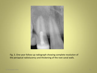 27 November 2016 60
Fig. 3. One-year follow-up radiograph showing complete resolution of
the periapical radiolucency and thickening of the root canal walls.
 