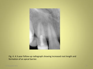 27 November 2016 61
Fig. 4. A 3-year follow-up radiograph showing increased root length and
formation of an apical barrier.
 