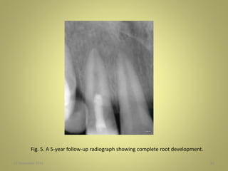 27 November 2016 62
Fig. 5. A 5-year follow-up radiograph showing complete root development.
 