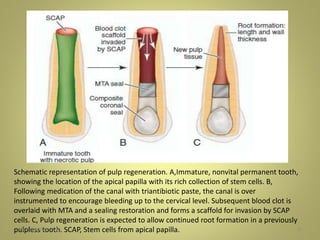9
Schematic representation of pulp regeneration. A,Immature, nonvital permanent tooth,
showing the location of the apical papilla with its rich collection of stem cells. B,
Following medication of the canal with triantibiotic paste, the canal is over
instrumented to encourage bleeding up to the cervical level. Subsequent blood clot is
overlaid with MTA and a sealing restoration and forms a scaffold for invasion by SCAP
cells. C, Pulp regeneration is expected to allow continued root formation in a previously
pulpless tooth. SCAP, Stem cells from apical papilla.27 November 2016
 