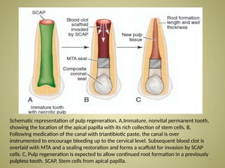 Advanced Revascularization Techniques in Endodontics for Immature Teeth ...