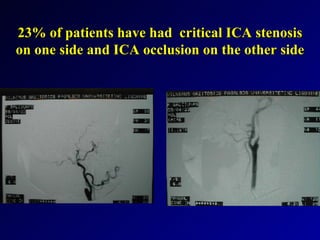 Revascularisation of the Brain In Acute Stroke | PPT