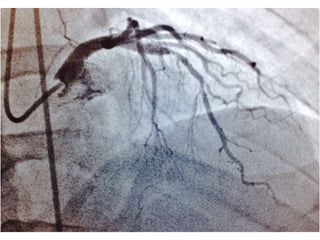 Revascularizacioncoronariaendiabetesamn2017