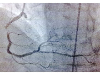 Revascularizacioncoronariaendiabetesamn2017