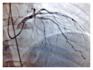 Revascularizacioncoronariaendiabetesamn2017