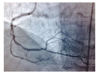 Revascularizacioncoronariaendiabetesamn2017