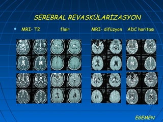SEREBRAL REVASKÜLARİZASYON
   MRI- T2   flair   MRI- difüzyon   ADC haritası




                                         EGEMEN
 