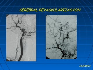 SEREBRAL REVASKÜLARİZASYON




                         EGEMEN
 