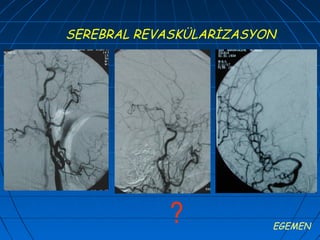 SEREBRAL REVASKÜLARİZASYON




            ?            EGEMEN
 