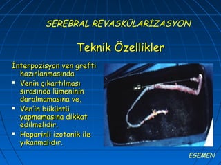 SEREBRAL REVASKÜLARİZASYON

                  Teknik Özellikler
İnterpozisyon ven grefti
  hazırlanmasında
 Venin çıkartılması

  sırasında lümeninin
  daralmamasına ve,
 Ven’in büküntü

  yapmamasına dikkat
  edilmelidir.
 Heparinli izotonik ile

  yıkanmalıdır.
                                      EGEMEN
 