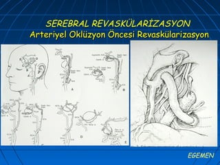 SEREBRAL REVASKÜLARİZASYON
Arteriyel Oklüzyon Öncesi Revaskülarizasyon




                                     EGEMEN
 