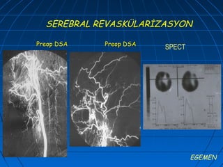 SEREBRAL REVASKÜLARİZASYON

Preop DSA   Preop DSA
                        SPECT




                                EGEMEN
 
