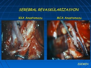 SEREBRAL REVASKÜLARİZASYON

KKA Anastomozu   MCA Anastomozu




                            EGEMEN
 