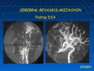 SEREBRAL REVASKÜLARİZASYON
      Postop DSA




                         EGEMEN
 