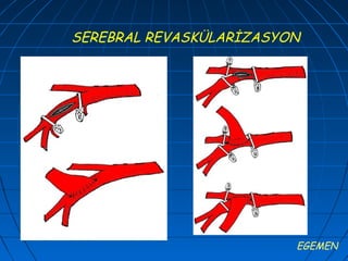 SEREBRAL REVASKÜLARİZASYON




                         EGEMEN
 
