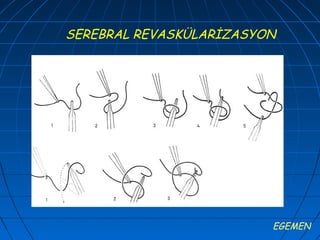 SEREBRAL REVASKÜLARİZASYON




                         EGEMEN
 