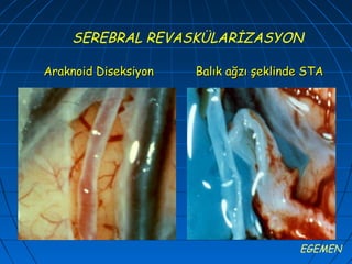 SEREBRAL REVASKÜLARİZASYON

Araknoid Diseksiyon   Balık ağzı şeklinde STA




                                        EGEMEN
 