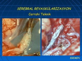 SEREBRAL REVASKÜLARİZASYON
     Cerrahi Teknik




                         EGEMEN
 