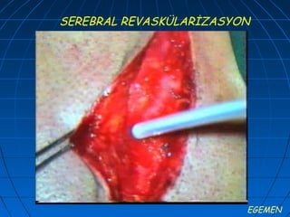 SEREBRAL REVASKÜLARİZASYON




                         EGEMEN
 