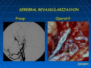 SEREBRAL REVASKÜLARİZASYON

Preop            Operatif




                            EGEMEN
 