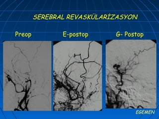 SEREBRAL REVASKÜLARİZASYON

Preop          E-postop     G- Postop




                                  EGEMEN
 