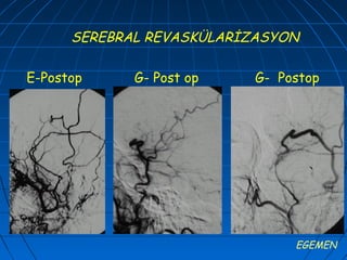 SEREBRAL REVASKÜLARİZASYON

E-Postop     G- Post op    G- Postop




                                EGEMEN
 