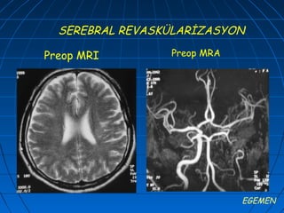SEREBRAL REVASKÜLARİZASYON

Preop MRI        Preop MRA




                             EGEMEN
 