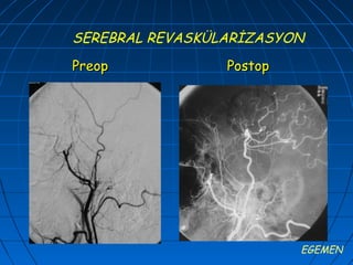 SEREBRAL REVASKÜLARİZASYON
Preop            Postop




                          EGEMEN
 