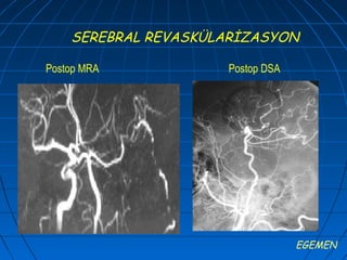 SEREBRAL REVASKÜLARİZASYON

Postop MRA           Postop DSA




                                  EGEMEN
 