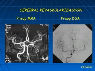 SEREBRAL REVASKÜLARİZASYON

Preop MRA         Preop DSA




                              EGEMEN
 