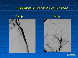 SEREBRAL REVASKÜLARİZASYON

Preop             Preop




                          EGEMEN
 