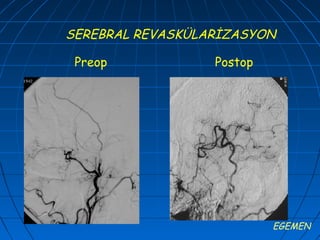 SEREBRAL REVASKÜLARİZASYON

 Preop            Postop




                           EGEMEN
 