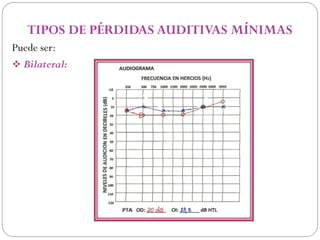 TIPOS DE PÉRDIDAS AUDITIVAS MÍNIMAS
Puede ser:
 Bilateral:
 