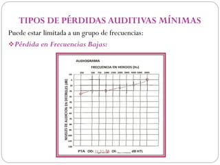TIPOS DE PÉRDIDAS AUDITIVAS MÍNIMAS
Puede estar limitada a un grupo de frecuencias:
Pérdida en Frecuencias Bajas:
 