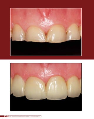 Reabilitação estética anteRioR com coRoas totais ametálicas Utilizando-se ceRâmica RefoRçada poR dissilicato de lítio




276    Clínica - International Journal of Brazilian Dentistry, Florianópolis, v.7, n.3, p. 276-282, jul./set. 2011
 