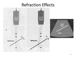 Refraction Artifact Example Reverberation Artifacts in ultrasound imaging | PDF