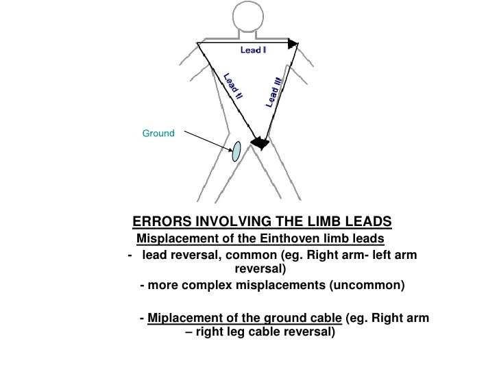 Reversal Limb Leads