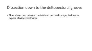 Dissection down to the deltopectoral groove
• Blunt dissection between deltoid and pectoralis major is done to
expose clavipectoralfascia.
 