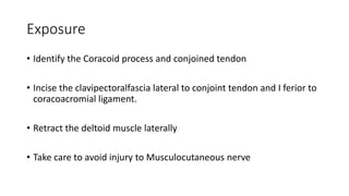 Exposure
• Identify the Coracoid process and conjoined tendon
• Incise the clavipectoralfascia lateral to conjoint tendon and I ferior to
coracoacromial ligament.
• Retract the deltoid muscle laterally
• Take care to avoid injury to Musculocutaneous nerve
 