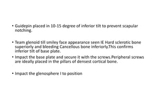 • Guidepin placed in 10-15 degree of inferior tilt to prevent scapular
notching.
• Team glenoid till smiley face appearance seen IE Hard sclerotic bone
superiorly and bleeding Cancellous bone inferiorly.This confirms
inferior tilt of base plate.
• Impact the base plate and secure it with the screws.Peripheral screws
are ideally placed in the pillars of densest cortical bone.
• Impact the glenosphere I to position
 