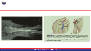 Shouder Rfa reverse shouder arthroplasty technique ppt | PPTX