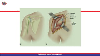 Shouder Rfa reverse shouder arthroplasty technique ppt | PPTX