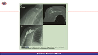 Shouder Rfa reverse shouder arthroplasty technique ppt | PPTX