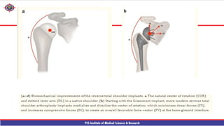 Shouder Rfa reverse shouder arthroplasty technique ppt | PPTX