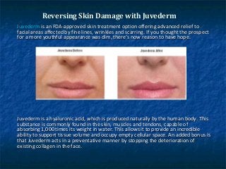 Reversing Skin Damage with JuvedermReversing Skin Damage with Juvederm
JuvedermJuvederm is an FDA-approved skin treatment option offering advanced relief tois an FDA-approved skin treatment option offering advanced relief to
facial areas affected by fine lines, wrinkles and scarring. If you thought the prospectfacial areas affected by fine lines, wrinkles and scarring. If you thought the prospect
for a more youthful appearance was dim, there’s now reason to have hope.for a more youthful appearance was dim, there’s now reason to have hope.
Juvederm is a hyaluronic acid, which is produced naturally by the human body. ThisJuvederm is a hyaluronic acid, which is produced naturally by the human body. This
substance is commonly found in the skin, muscles and tendons, capable ofsubstance is commonly found in the skin, muscles and tendons, capable of
absorbing 1,000 times its weight in water. This allows it to provide an incredibleabsorbing 1,000 times its weight in water. This allows it to provide an incredible
ability to support tissue volume and occupy empty cellular space. An added bonus isability to support tissue volume and occupy empty cellular space. An added bonus is
that Juvederm acts in a preventative manner by stopping the deterioration ofthat Juvederm acts in a preventative manner by stopping the deterioration of
existing collagen in the face.existing collagen in the face.
 