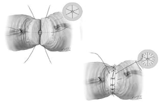 GranulomaCOMPARAÇÃO ENTRE TÉCNICAS