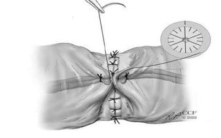REVERSÃO DE VASECTOMIA