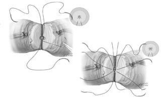 REMANESCENTE DO COTO TESTICULAR						Sperm Present# men%> 2.7 cm			30/32		94%< 2.7 cm			 3/20			15%Witt M, Heron S, Lipshultz LI: J Urol 151:892, 1994.